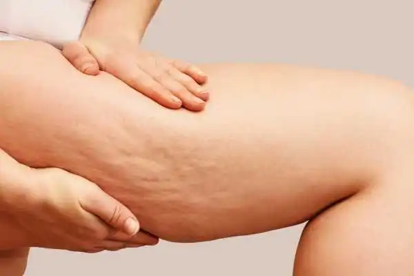 Image of woman showing leg with cellulite Spring Bank