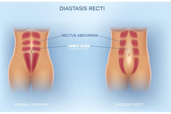 What Non-Surgical Options Are Available for Diastasis Recti Spring Bank?