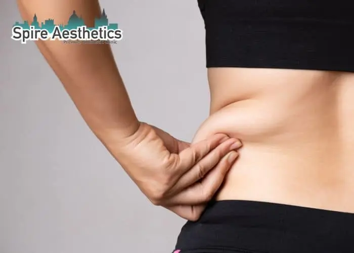 Image of woman pinching fat on their hips Spring Bank. Fat Freezing treatment