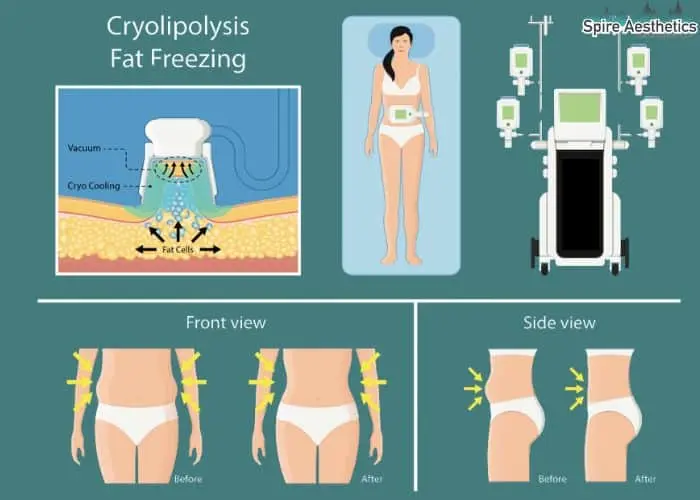Fat freezing treatment Spring Bank benefits for competitions to remove stubborn fat deposits.